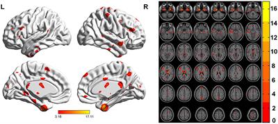 Resting-state functional MRI study of conventional MRI-negative intractable epilepsy in children